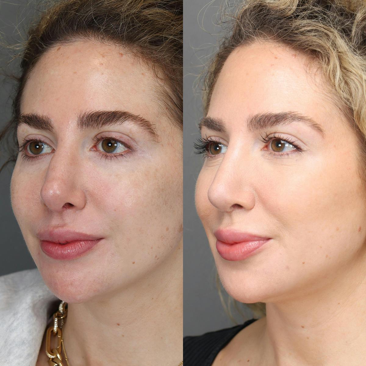 Revision Rhinoplasty Before & After Gallery - Patient 156925 - Image 4