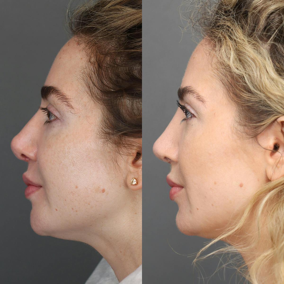 Revision Rhinoplasty Before & After Gallery - Patient 156925 - Image 5