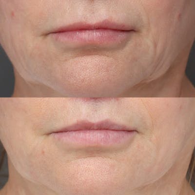 Lip Lifts Before & After Gallery - Patient 241962 - Image 1