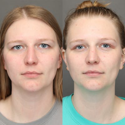 Eyelifts & Blepharoplasty Before & After Gallery - Patient 185261 - Image 1