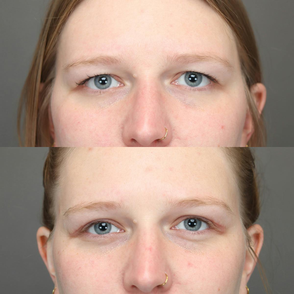 Eyelifts & Blepharoplasty Before & After Gallery - Patient 185261 - Image 2