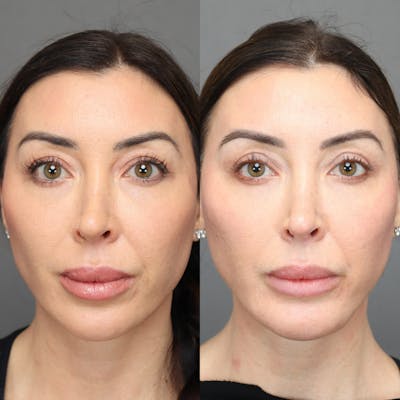 Eyelifts & Blepharoplasty Before & After Gallery - Patient 630158 - Image 1