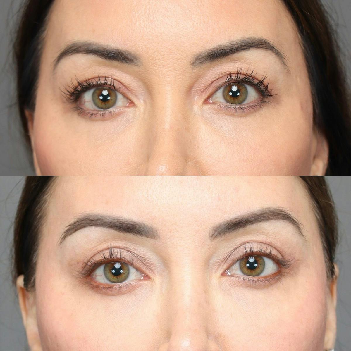 Eyelifts & Blepharoplasty Before & After Gallery - Patient 630158 - Image 2
