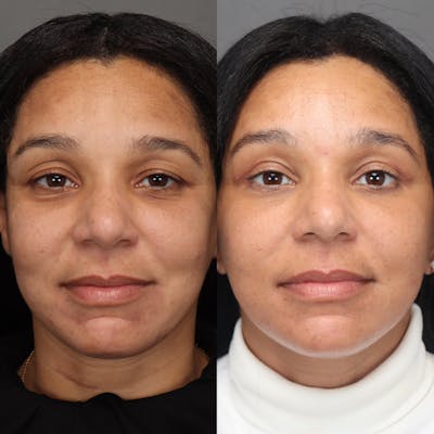 Eyelifts & Blepharoplasty Before & After Gallery - Patient 121488 - Image 1
