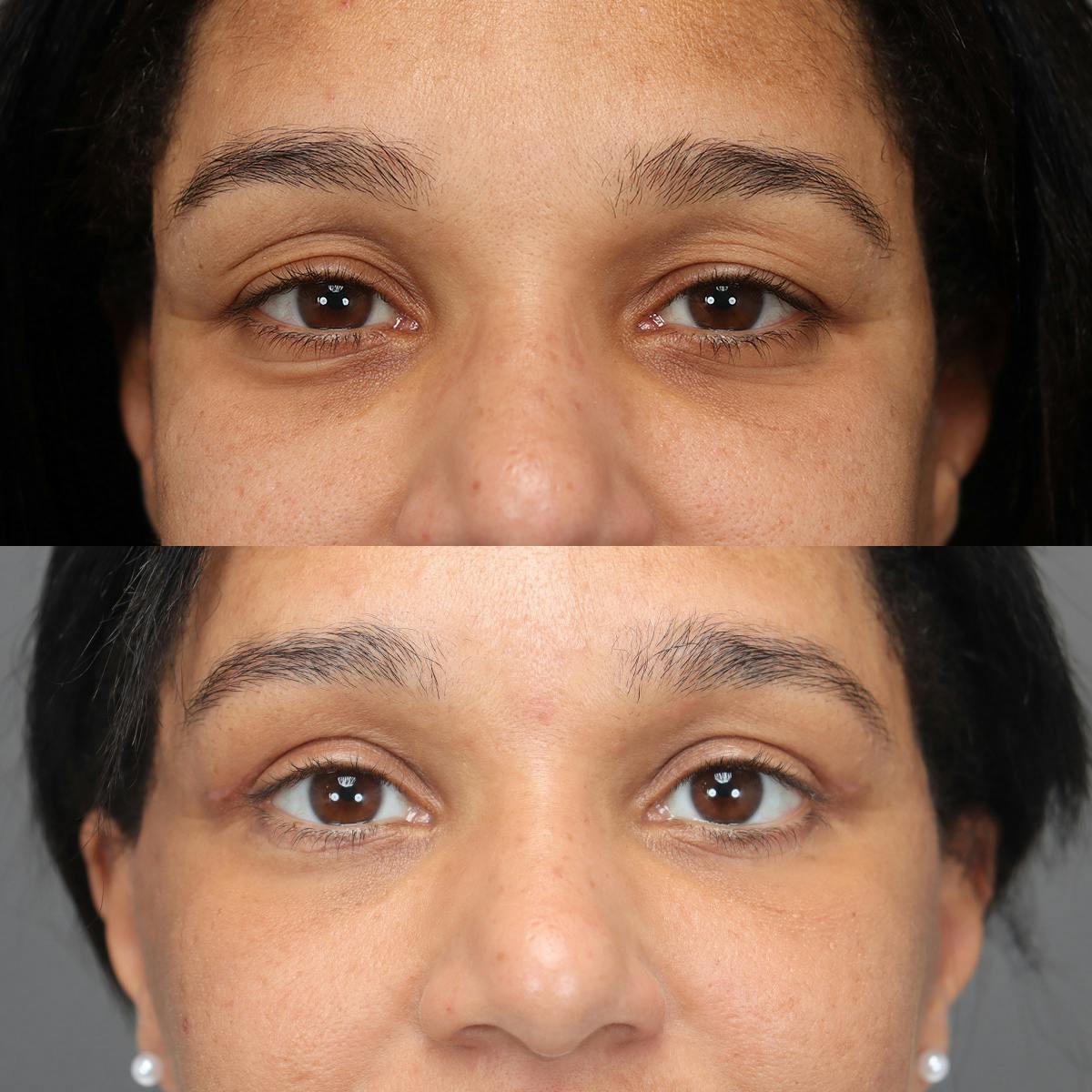 Eyelifts & Blepharoplasty Before & After Gallery - Patient 121488 - Image 2