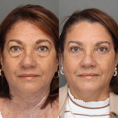 Eyelifts & Blepharoplasty Before & After Gallery - Patient 420237 - Image 1