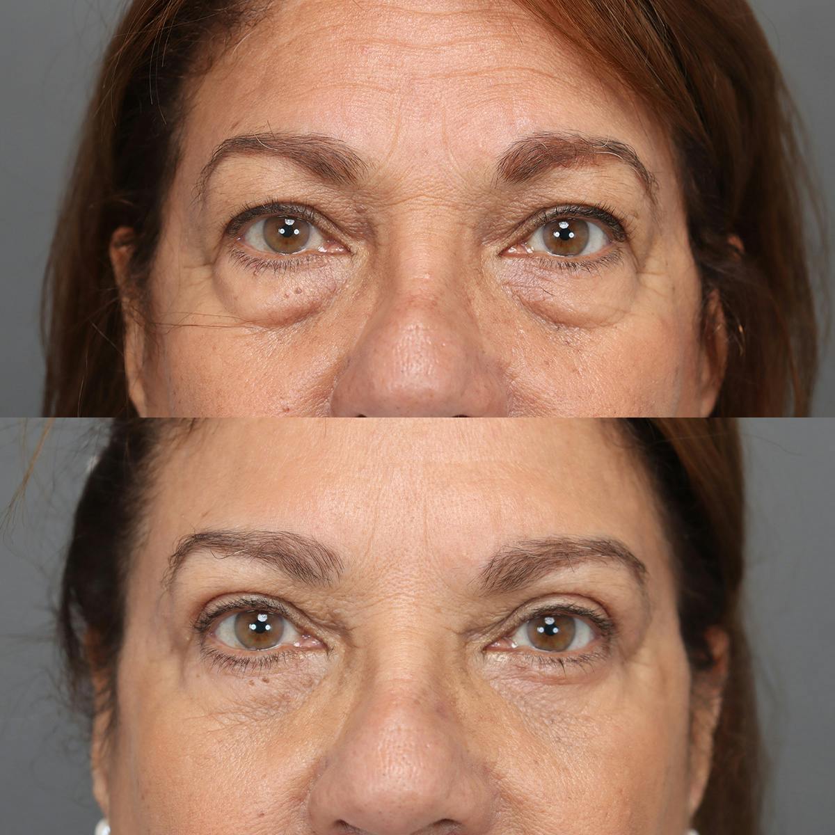 Eyelifts & Blepharoplasty Before & After Gallery - Patient 420237 - Image 2
