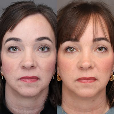 Eyelifts & Blepharoplasty Before & After Gallery - Patient 498014 - Image 1
