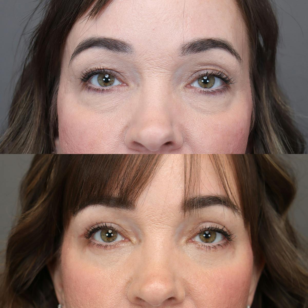 Eyelifts & Blepharoplasty Before & After Gallery - Patient 498014 - Image 2