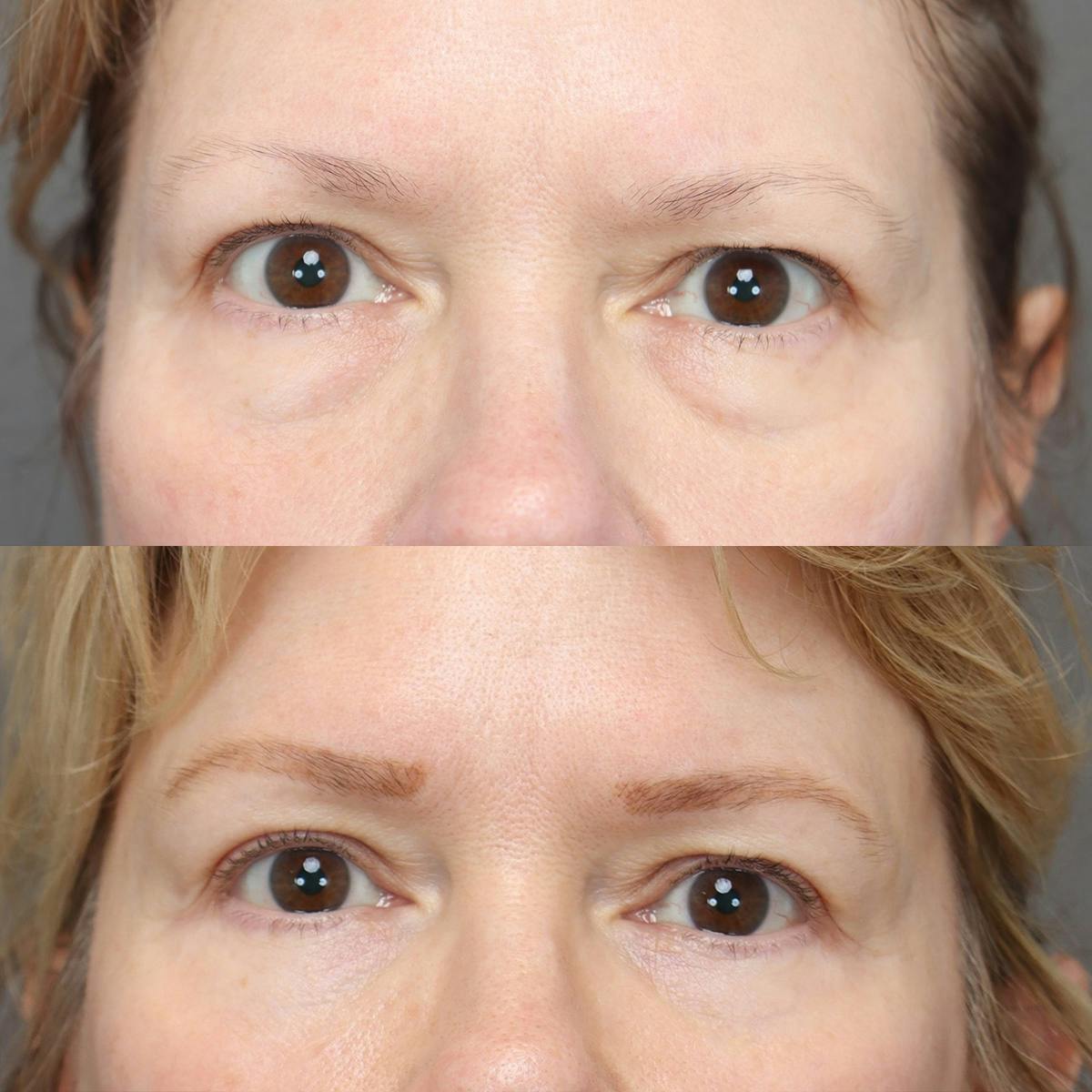 Eyelifts & Blepharoplasty Before & After Gallery - Patient 683687 - Image 1