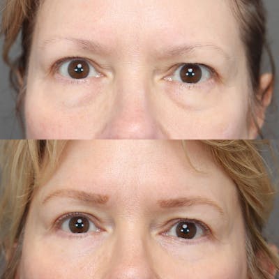 Eyelifts & Blepharoplasty Before & After Gallery - Patient 683687 - Image 1