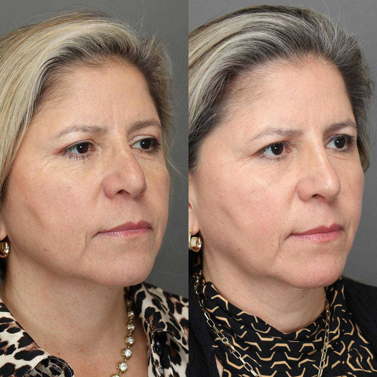 Revision Rhinoplasty Before & After Gallery - Patient 127947 - Image 2