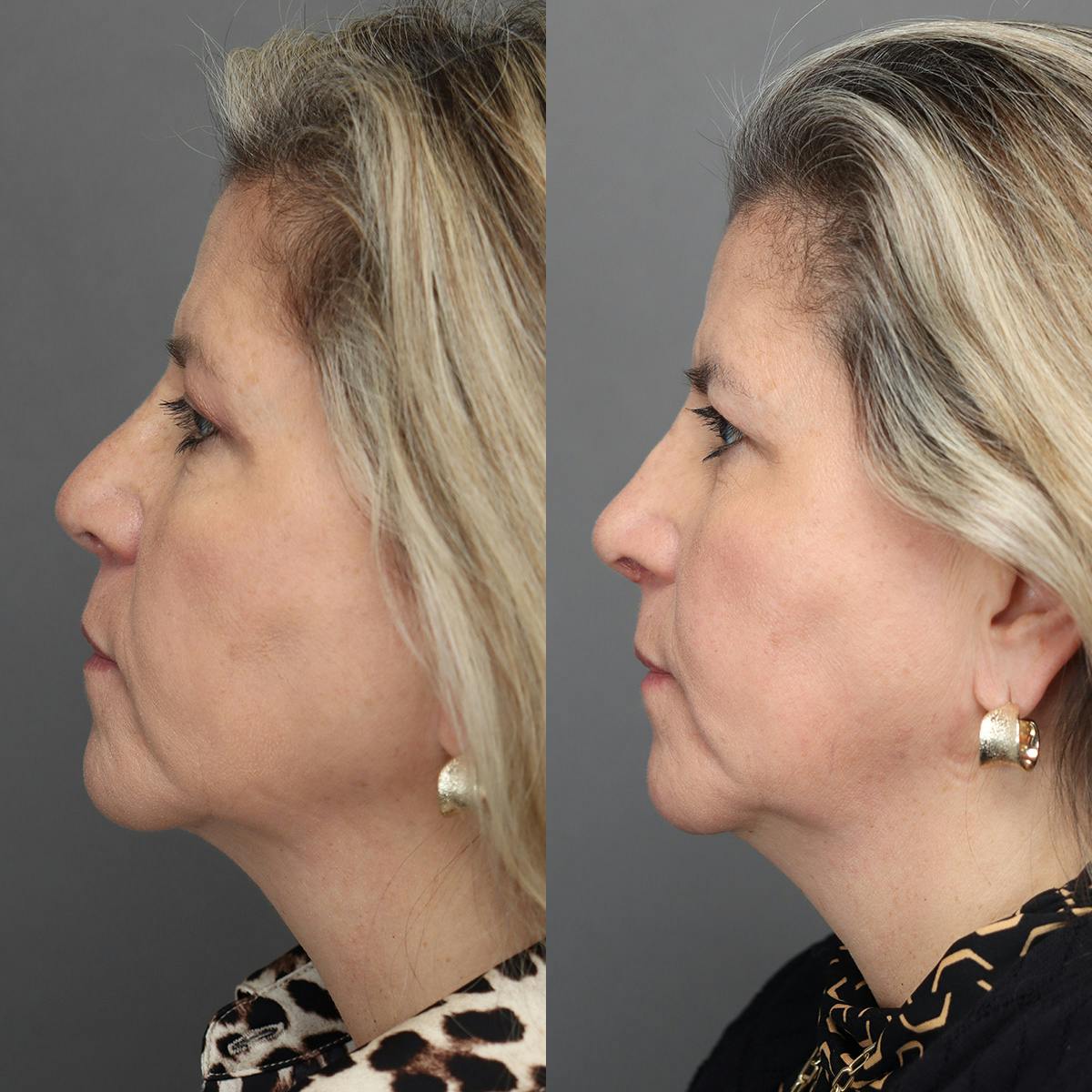 Revision Rhinoplasty Before & After Gallery - Patient 127947 - Image 5