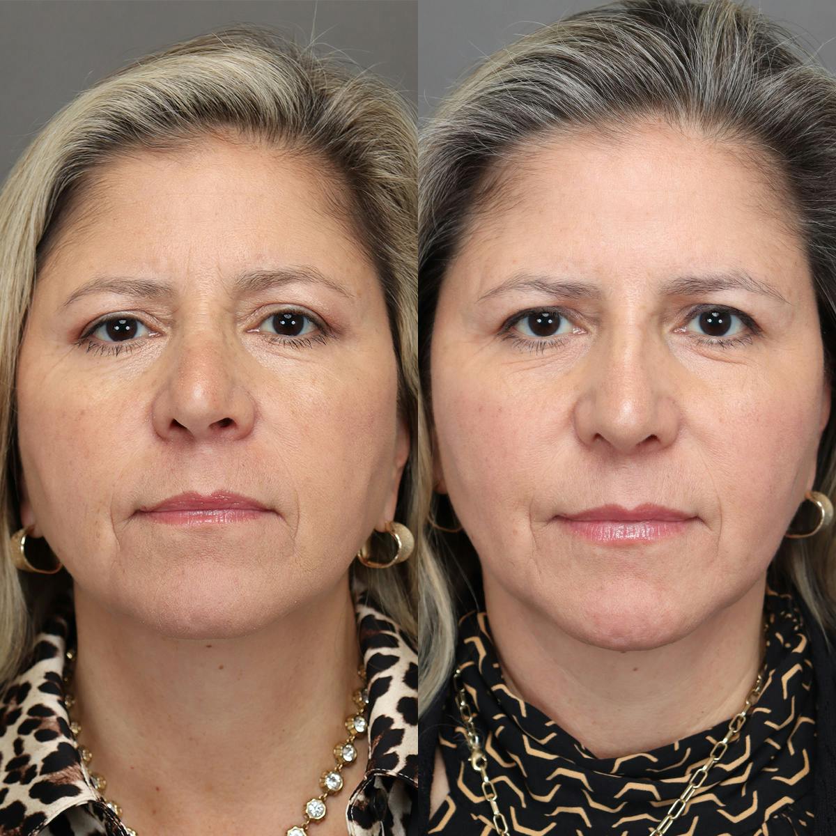 Revision Rhinoplasty Before & After Gallery - Patient 127947 - Image 3