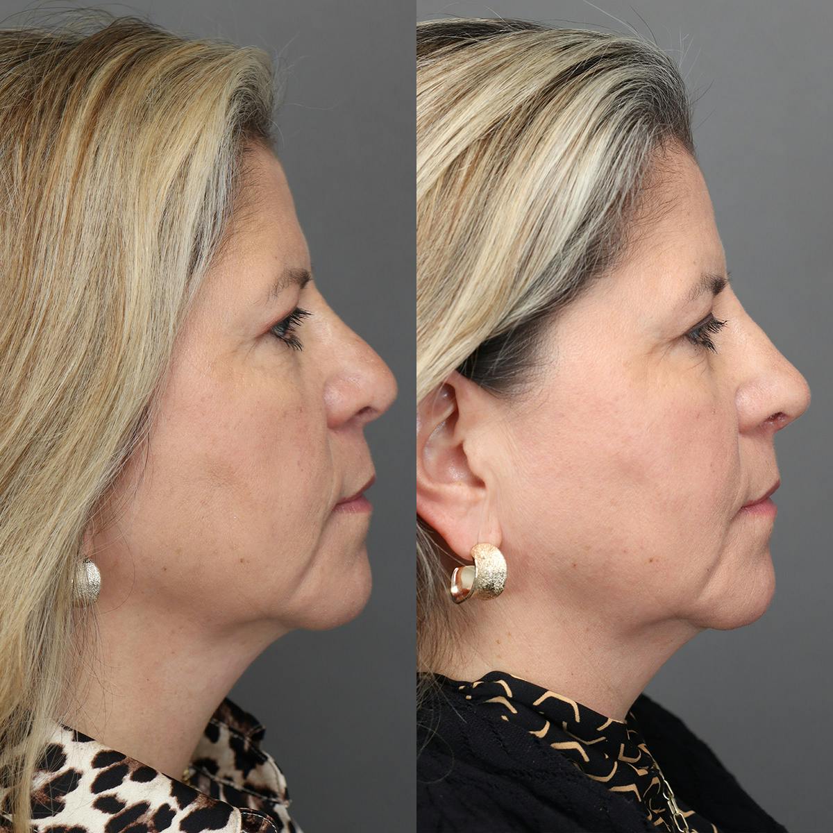 Revision Rhinoplasty Before & After Gallery - Patient 127947 - Image 1