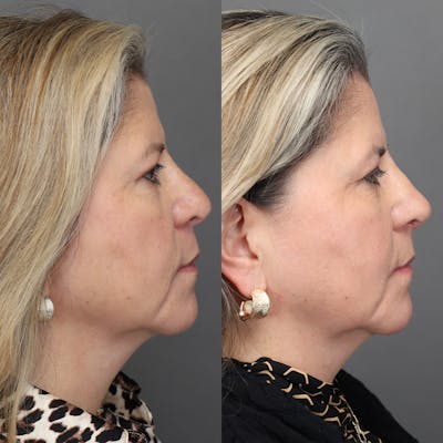 Revision Rhinoplasty Before & After Gallery - Patient 127947 - Image 1