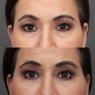 Eyelifts & Blepharoplasty Before & After Gallery - Patient 481173 - Image 1