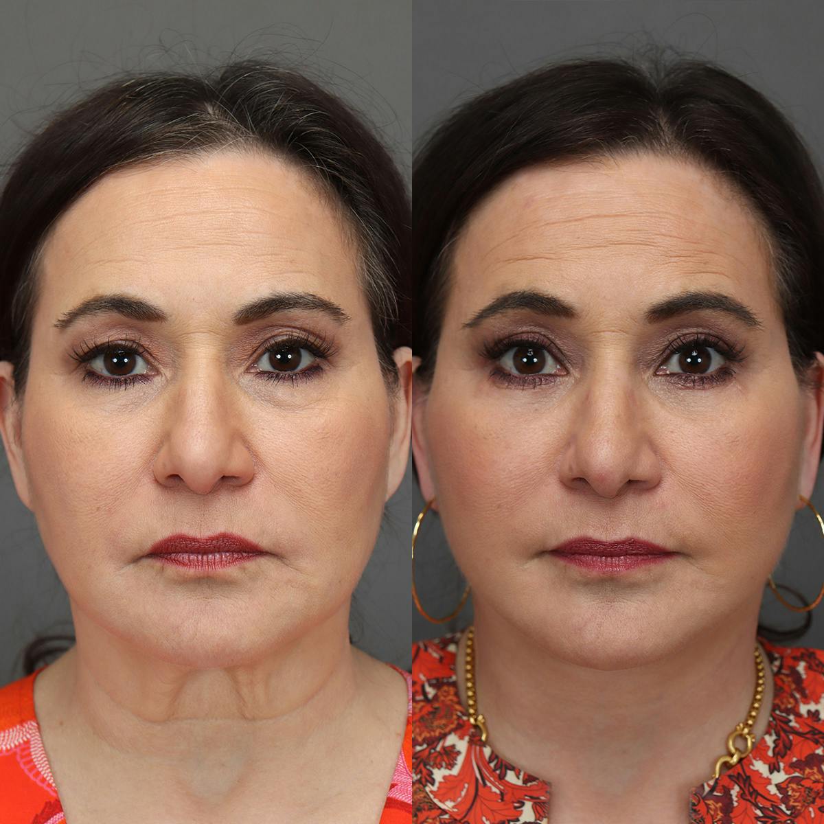 Eyelifts & Blepharoplasty Before & After Gallery - Patient 481173 - Image 2