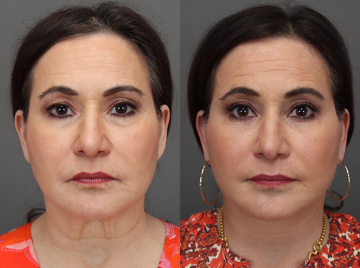 Facelifts Before & After Gallery - Patient 374861 - Image 1