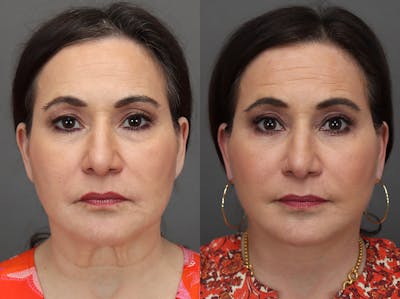 Facelifts Before & After Gallery - Patient 374861 - Image 1