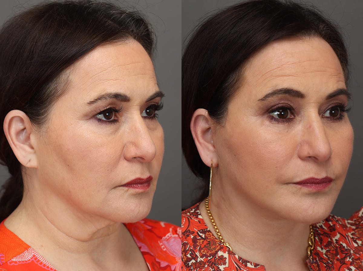 Facelifts Before & After Gallery - Patient 374861 - Image 2