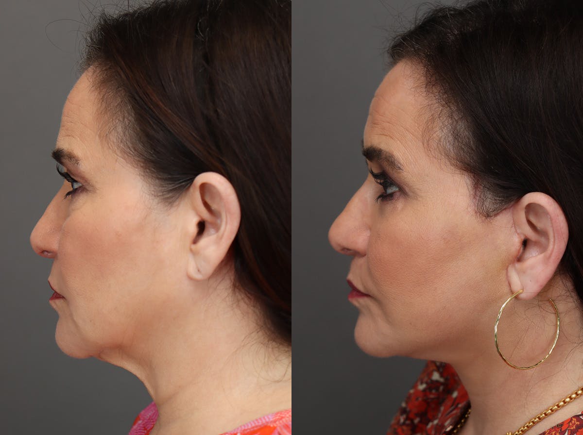 Facelifts Before & After Gallery - Patient 374861 - Image 3