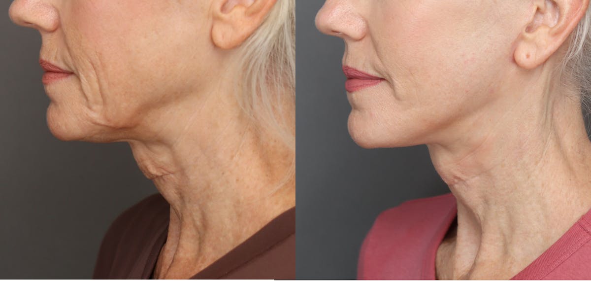 Facelifts Before & After Gallery - Patient 921470 - Image 3
