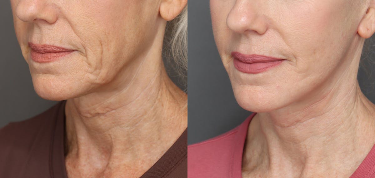 Facelifts Before & After Gallery - Patient 921470 - Image 2