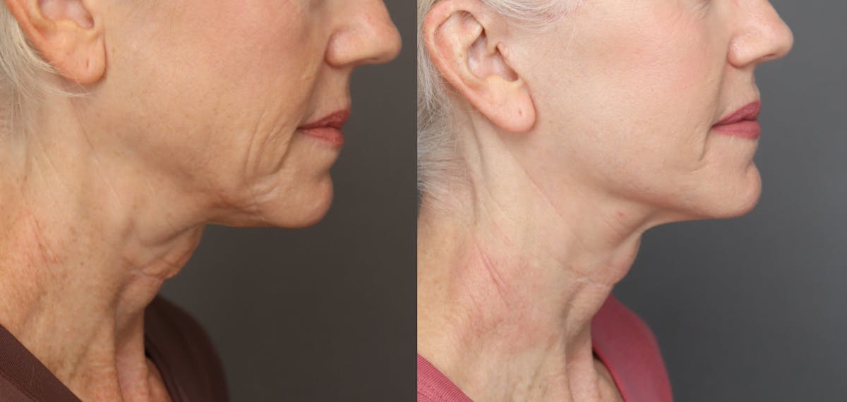Facelifts Before & After Gallery - Patient 921470 - Image 4