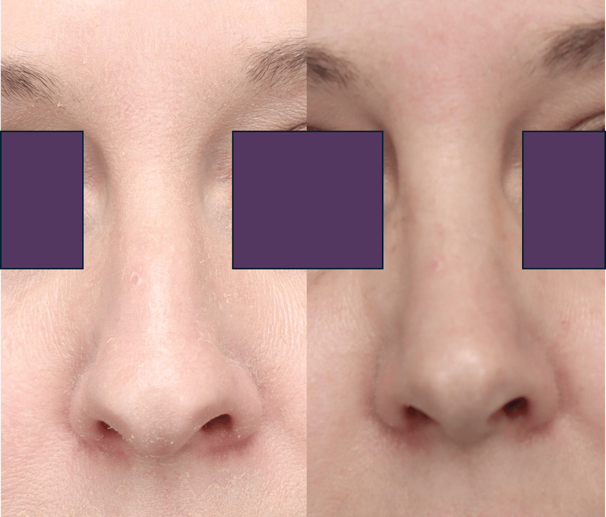 Rhinoplasty Before & After Gallery - Patient 230300 - Image 2
