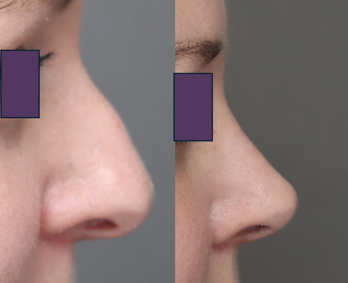 Rhinoplasty Before & After Gallery - Patient 230300 - Image 1