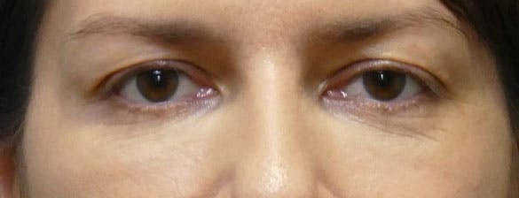 patient after