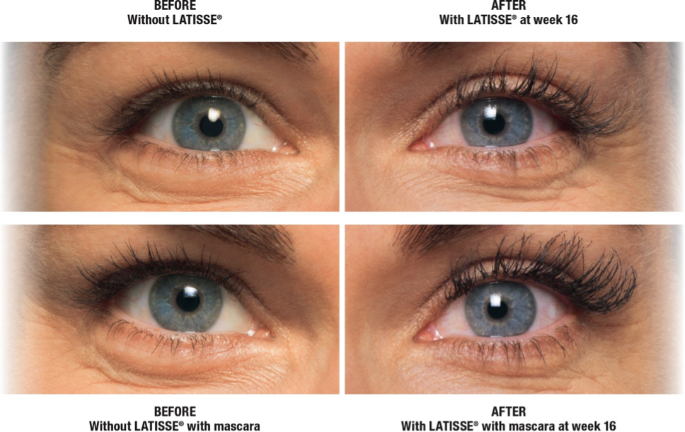 LATISSE® results