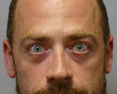 Eyelid Surgery Before & After Gallery - Patient 247944 - Image 2