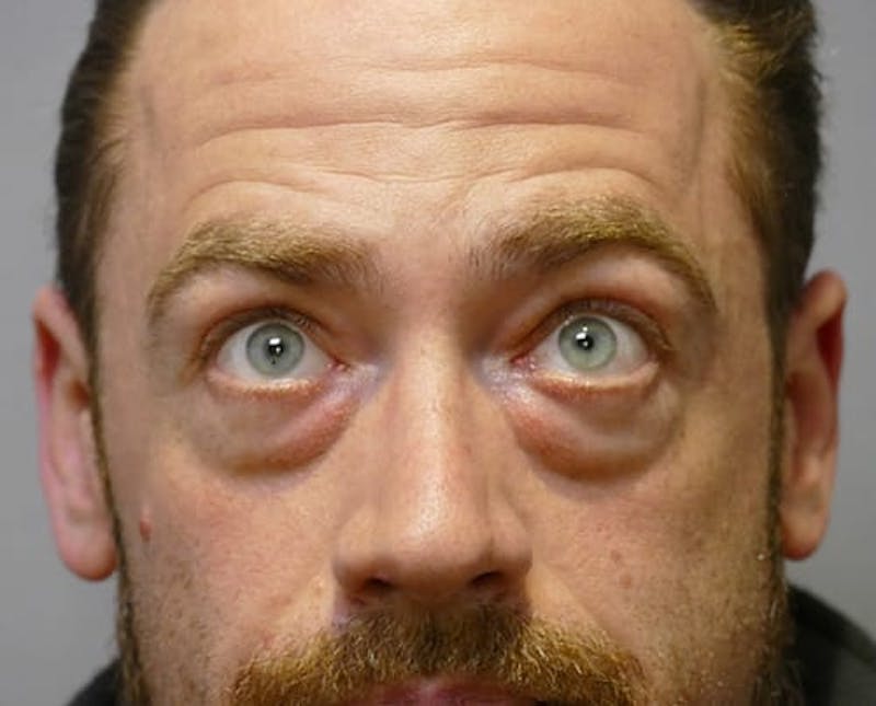 Eyelid Surgery Before & After Gallery - Patient 247944 - Image 1