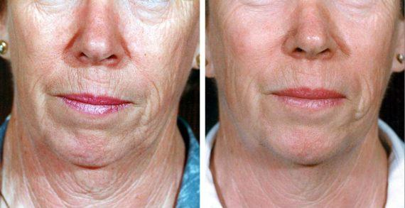 Before and after collagen treatment