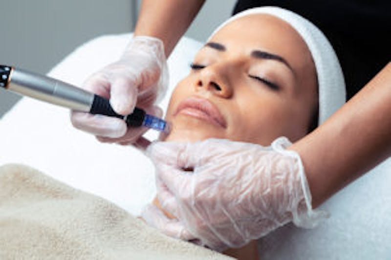 woman receiving microneedling treatment