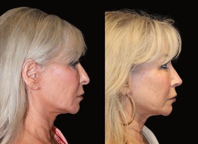 Rhinoplasty Before & After Gallery - Patient 213128 - Image 1
