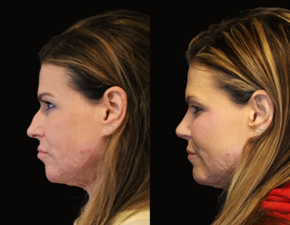 Rhinoplasty Before & After Gallery - Patient 108907 - Image 2