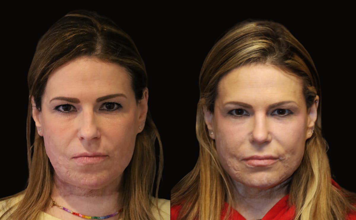 Rhinoplasty Before & After Gallery - Patient 108907 - Image 3