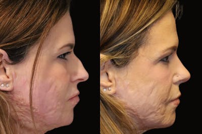 Rhinoplasty Before & After Gallery - Patient 108907 - Image 1