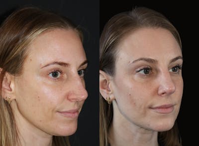 Rhinoplasty Before & After Gallery - Patient 340223 - Image 1