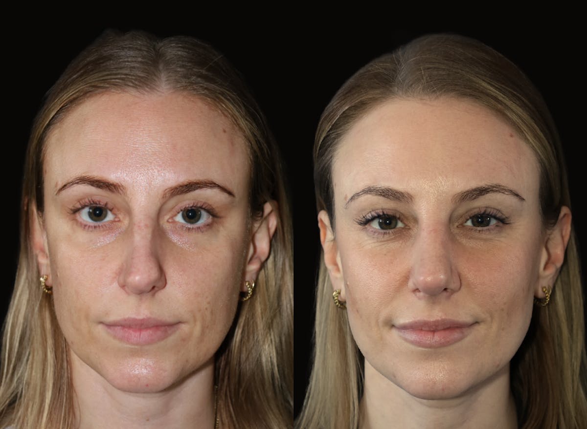 Rhinoplasty Before & After Gallery - Patient 340223 - Image 2