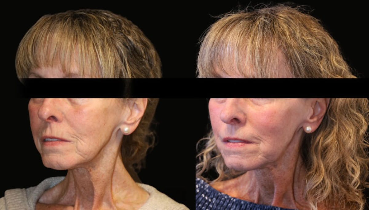 Rhinoplasty Before & After Gallery - Patient 336473 - Image 2