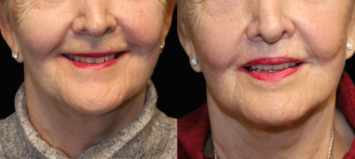 Lip Lift Before & After Gallery - Patient 216563 - Image 2