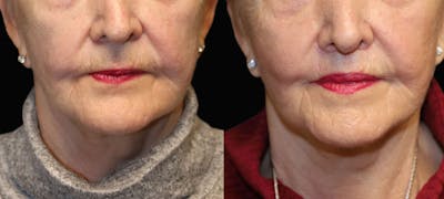 Lip Lift Before & After Gallery - Patient 216563 - Image 1