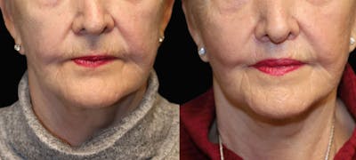 Lip Lift Before & After Gallery - Patient 216563 - Image 1