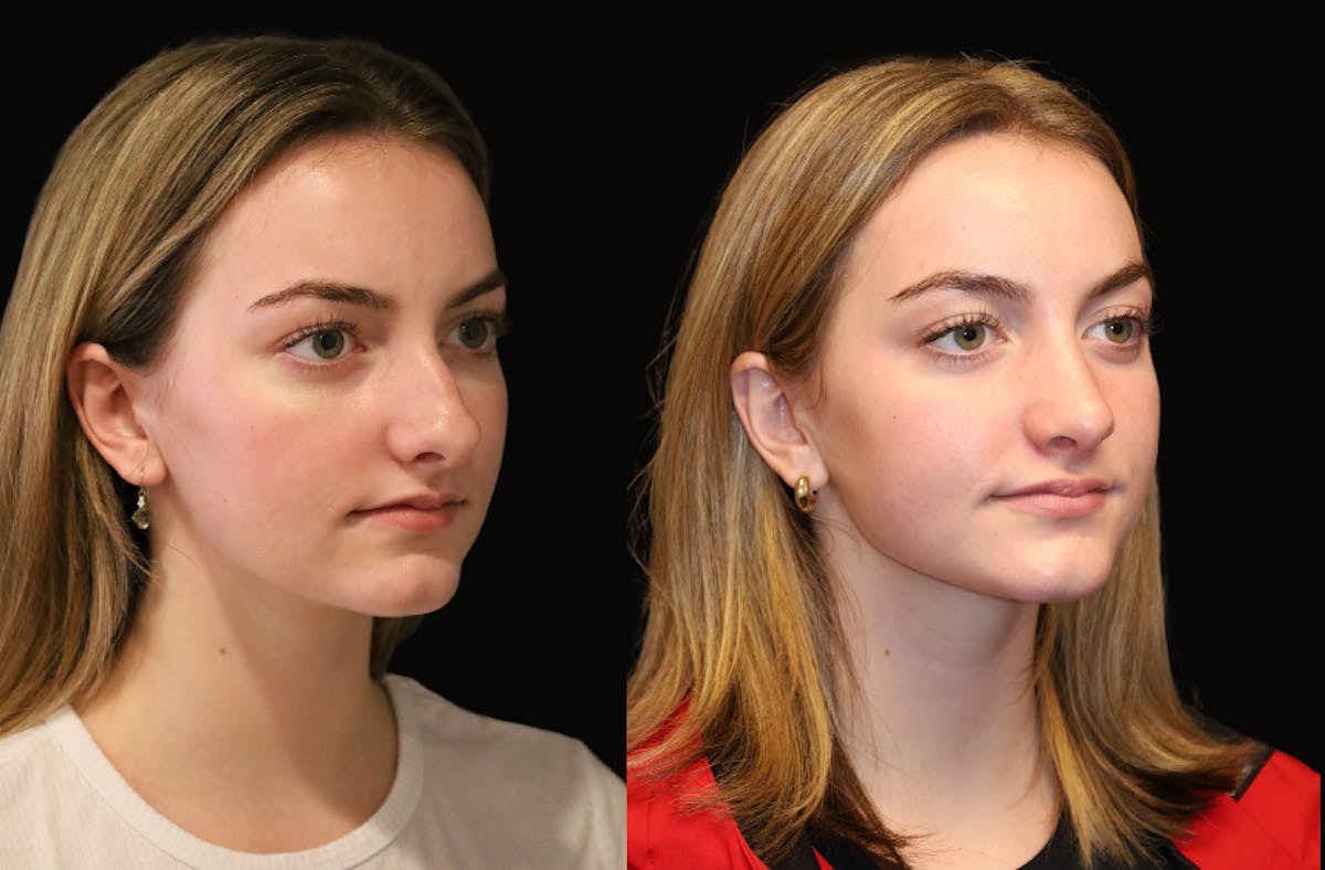 Rhinoplasty Before & After Gallery - Patient 202403 - Image 3