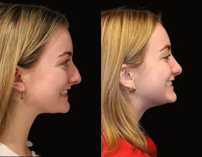 Rhinoplasty Before & After Gallery - Patient 202403 - Image 1