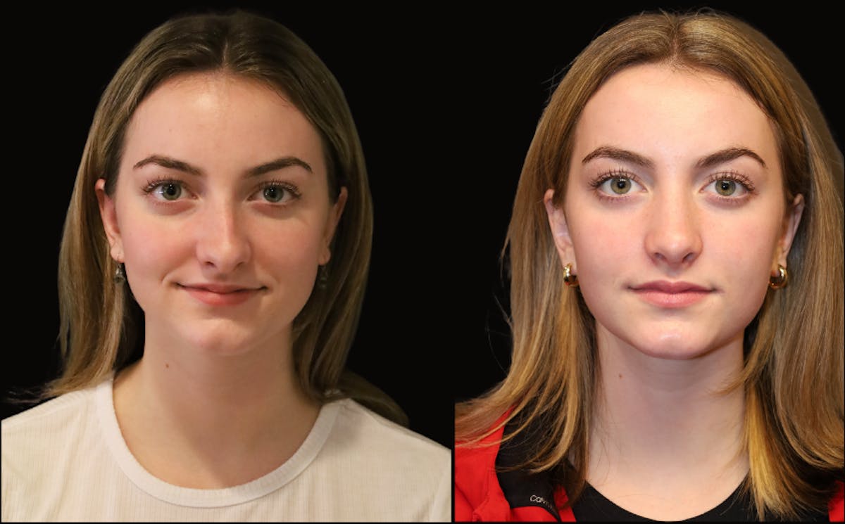 Rhinoplasty Before & After Gallery - Patient 202403 - Image 2